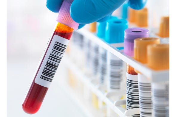 A Big Step toward a Blood Test for Alzheimer's