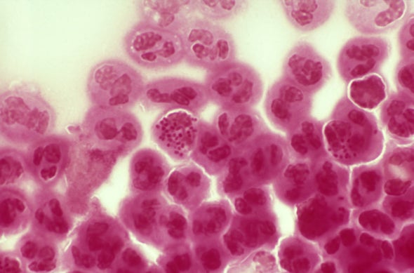 Untreatable Gonorrhea on the Rise Worldwide