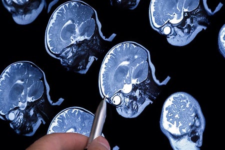 infant brain MRI