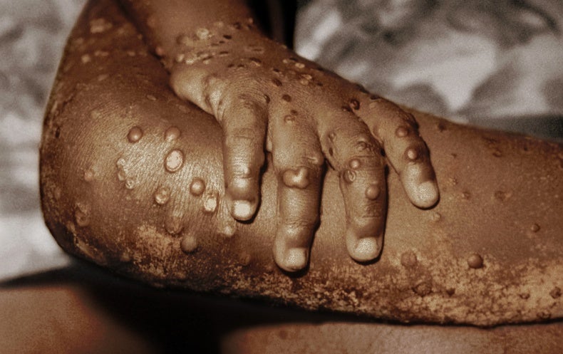 What is Monkeypox, the Virus Infecting People in the U.S. and Europe?