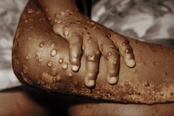 What Is Monkeypox, the Virus Infecting People in the U.S. and Europe?