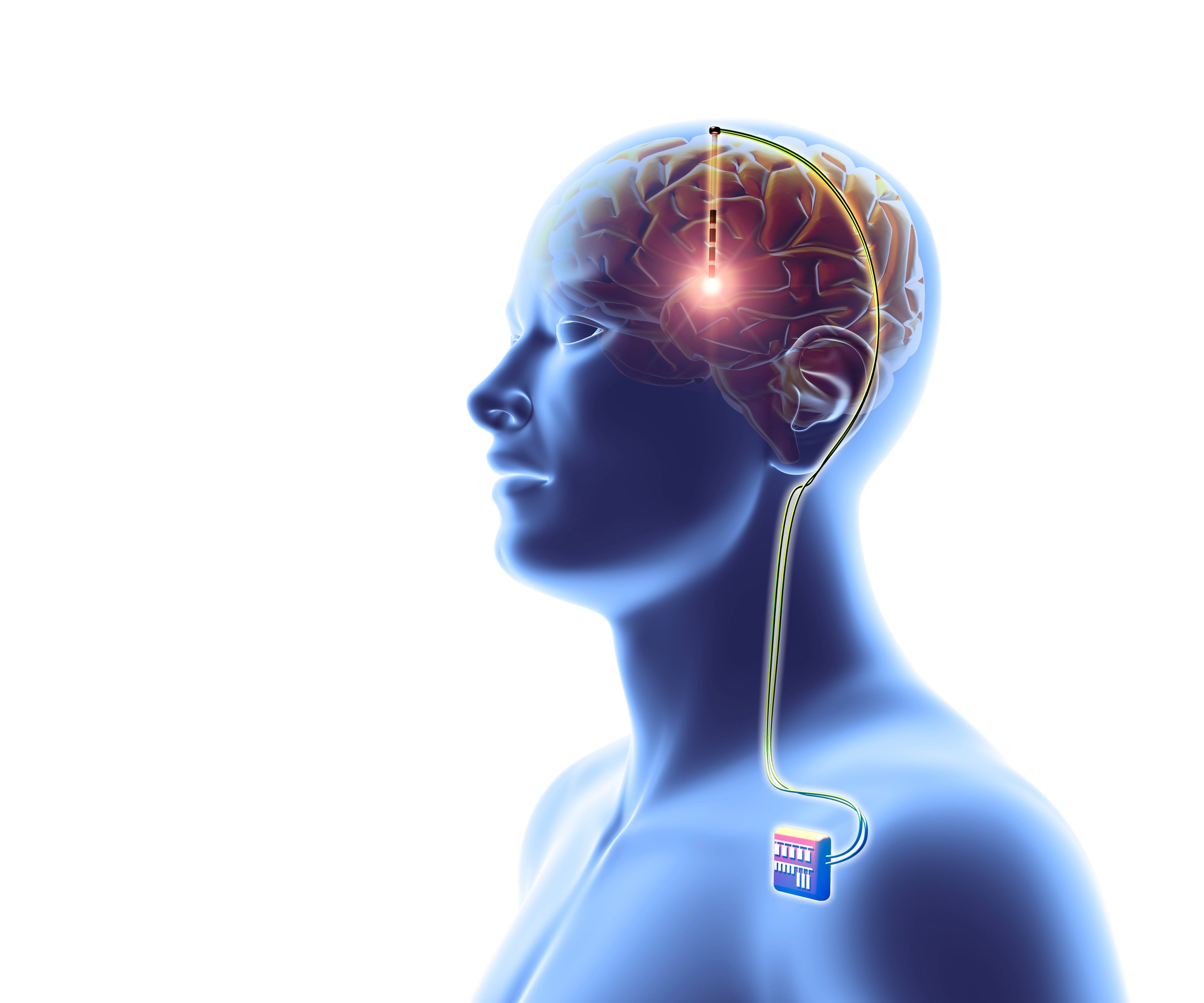It S Not My Fault My Brain Implant Made Me Do It Scientific American