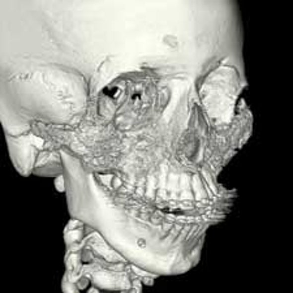 Stem Cells from Fat Used to Grow Teen's Missing Facial Bones