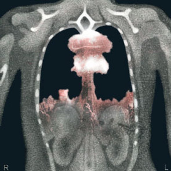 cancer from abdominal ct scan