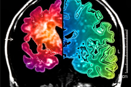 Alzheimer's brain comparison