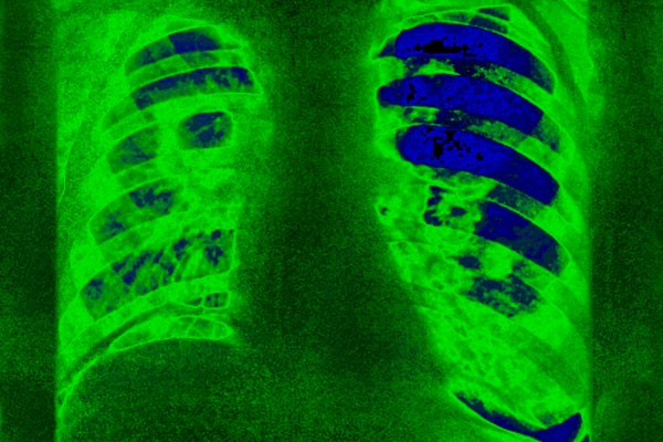 Green tinted X-ray with blue area identified as tuberculosis.