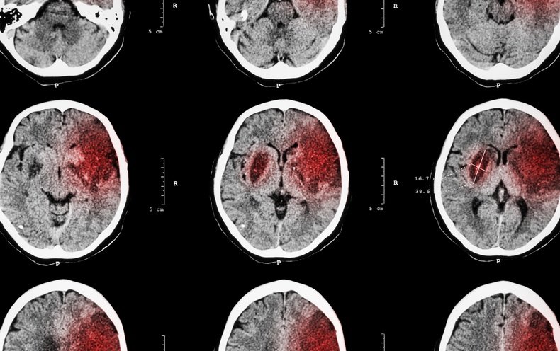 Targeting Inflammation May Protect and Restore the Brain after Stroke ...