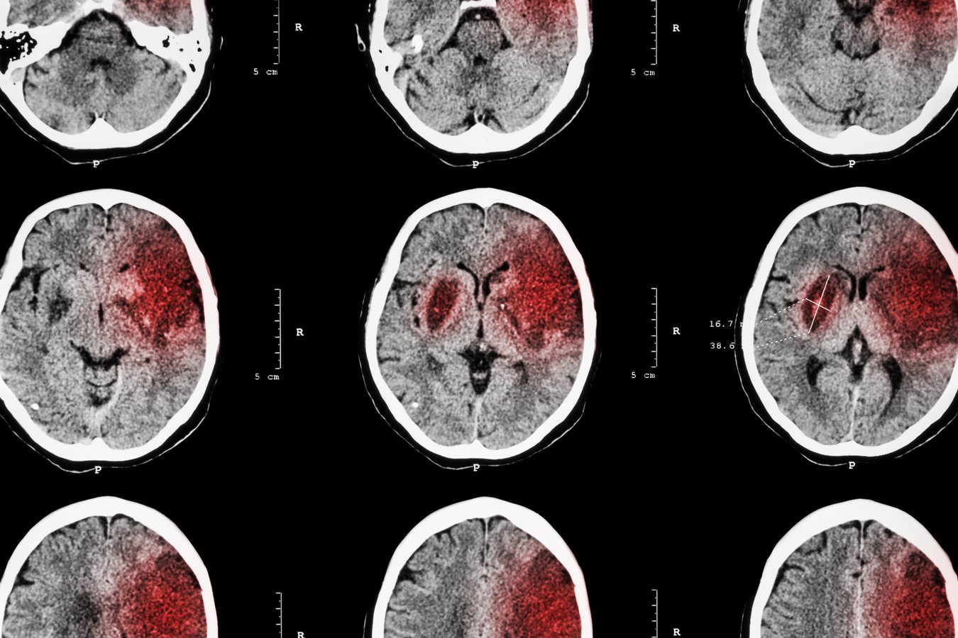 Targeting Inflammation May Protect and Restore the Brain after Stroke ...
