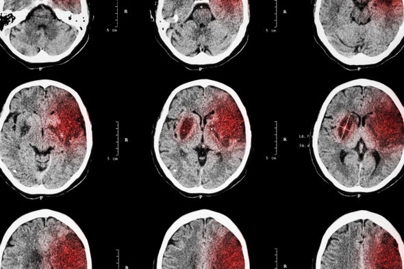 Targeting Inflammation May Protect and Restore the Brain after Stroke