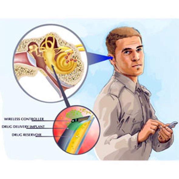 Buzz Kill: Self-Dissolving Tinnitus Treatment Gives New Hope