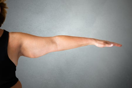 Overweight Lady Arm With Excess Fat.