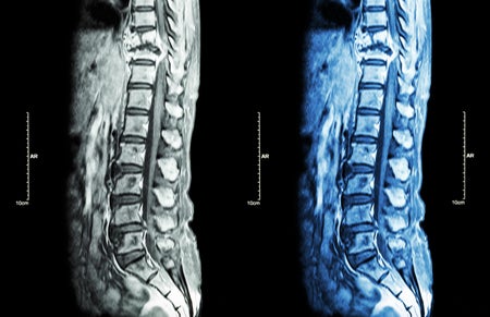 2 spine MRIs side by side.