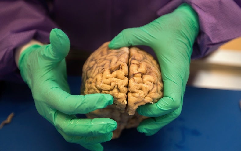 Brain disease CTE seen in most football players in large report