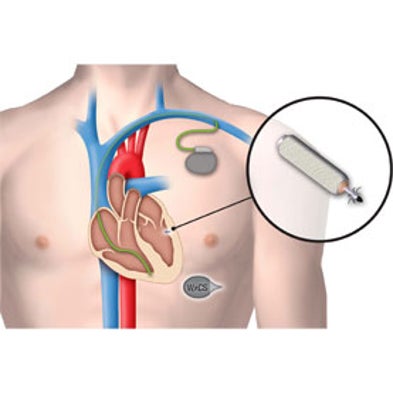 Easy to Beat: Next-Gen Cardiac Care Includes Wireless Pacemakers