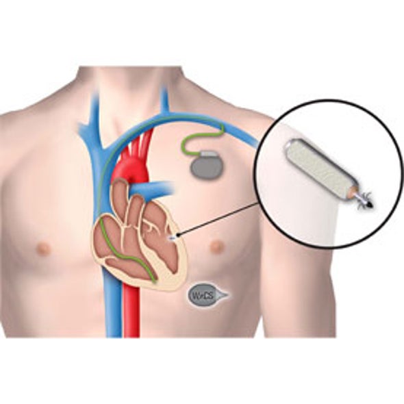 Easy to Beat: Next-Gen Cardiac Care Includes Wireless Pacemakers