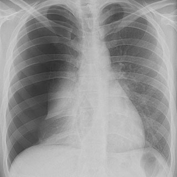 What is pneumothorax? Scientific American