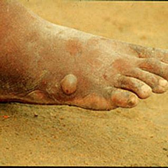 what-is-guinea-worm-disease-scientific-american