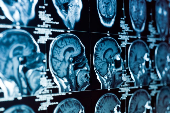 Stroke Study Sparks Call For Revamping Emergency Care Plan Scientific American