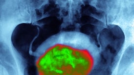 Men with Early Prostate Cancer Can Safely Opt Out of Treatment, Finds Landmark Study