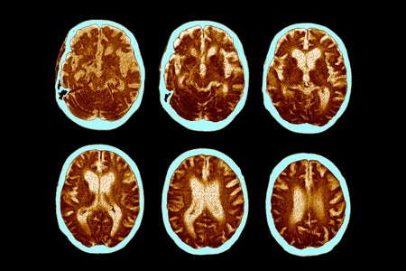 6 brain scans showing Alzheimer's disease