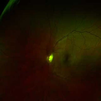 The Brain Adapts in a Blink to Compensate for Missing Information