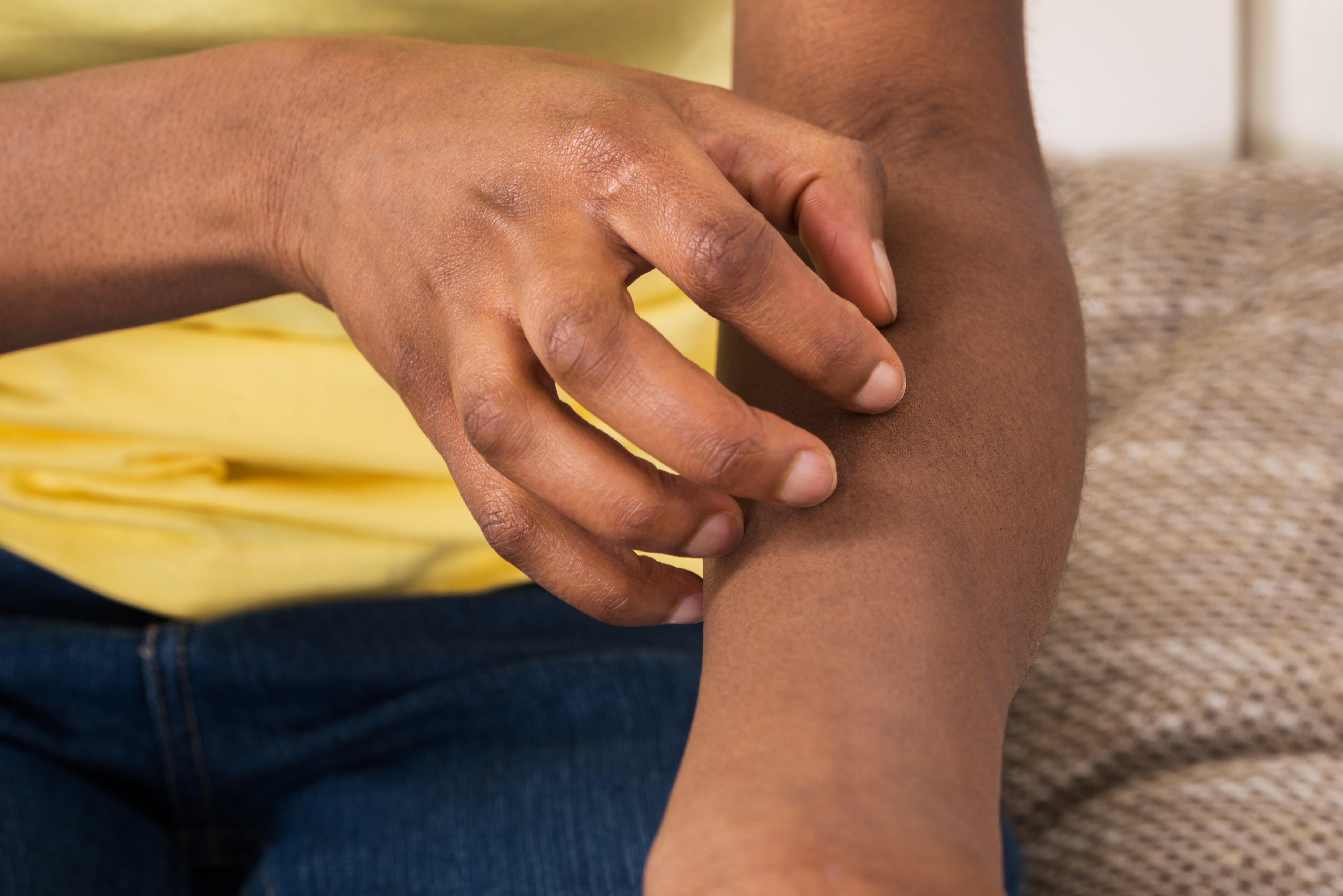 Scratch scar on arm stock image. Image of healthcare - 156865671