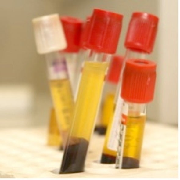 Arresting Development: Blood Biomarker Patterns May Aid Early Diagnosis of Ovarian Cancer