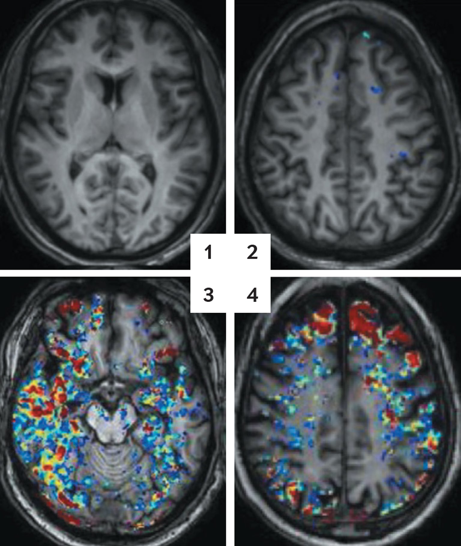 Brain scans, highlighting a colored tracer molecule in the blood, show more leaks in the blood-brain barrier as people age.