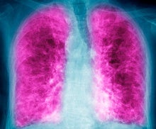 The Deadly Lung Disease You've Probably Never Heard Of