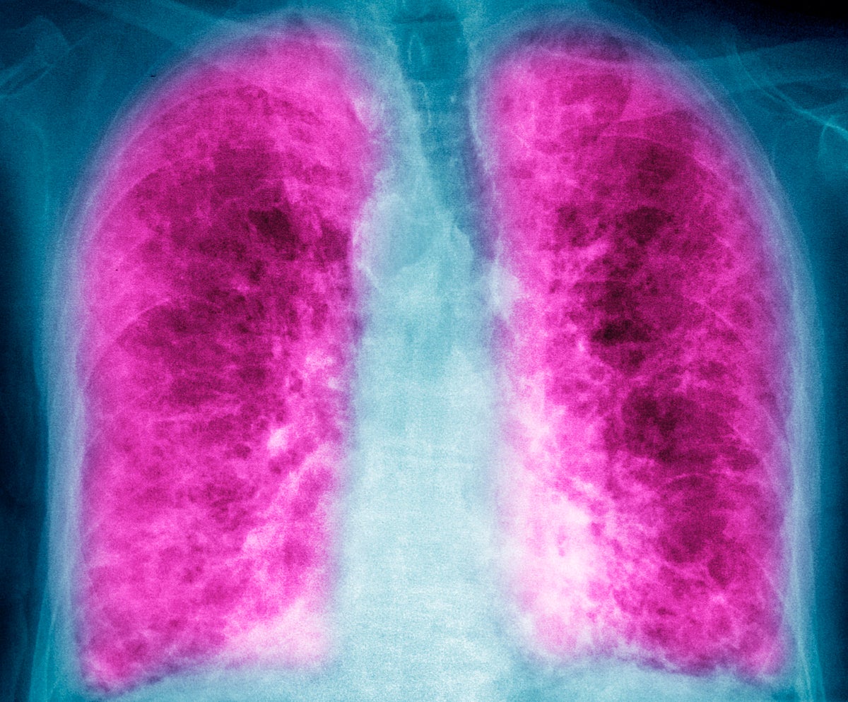 Can Mold Cause Lung Cancer?