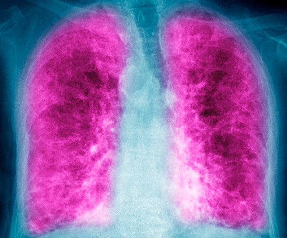 The Deadly Lung Disease You've Probably Never Heard Of