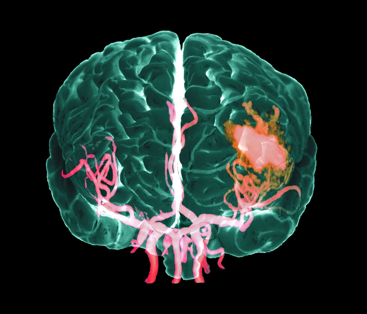 What Causes Strokes? | Scientific American