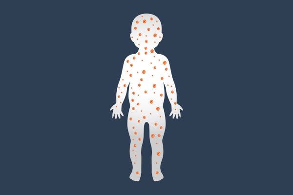 Measles logo icon design, vector illustration baby with dots on body