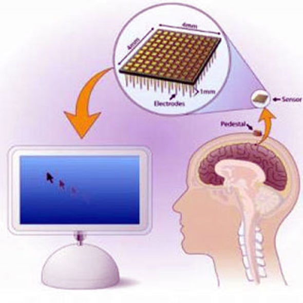 Plug and Play: Researchers Expand Clinical Study of Neural Interface Brain Implant