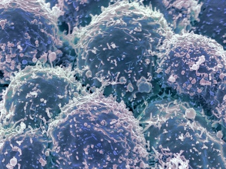A field of microscopic cancer cells, colored blue green, and stuck together in a mass
