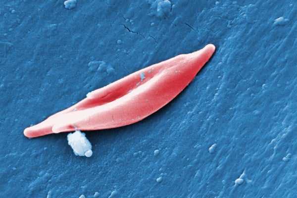 scanning electron micrograph (SEM) of sickle cell red blood cell (RCB)