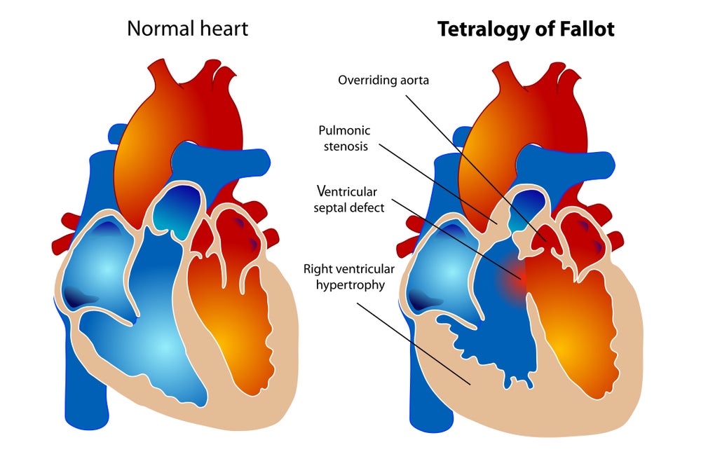 Billy Kimmel's Rare Heart Condition Explained | Scientific American